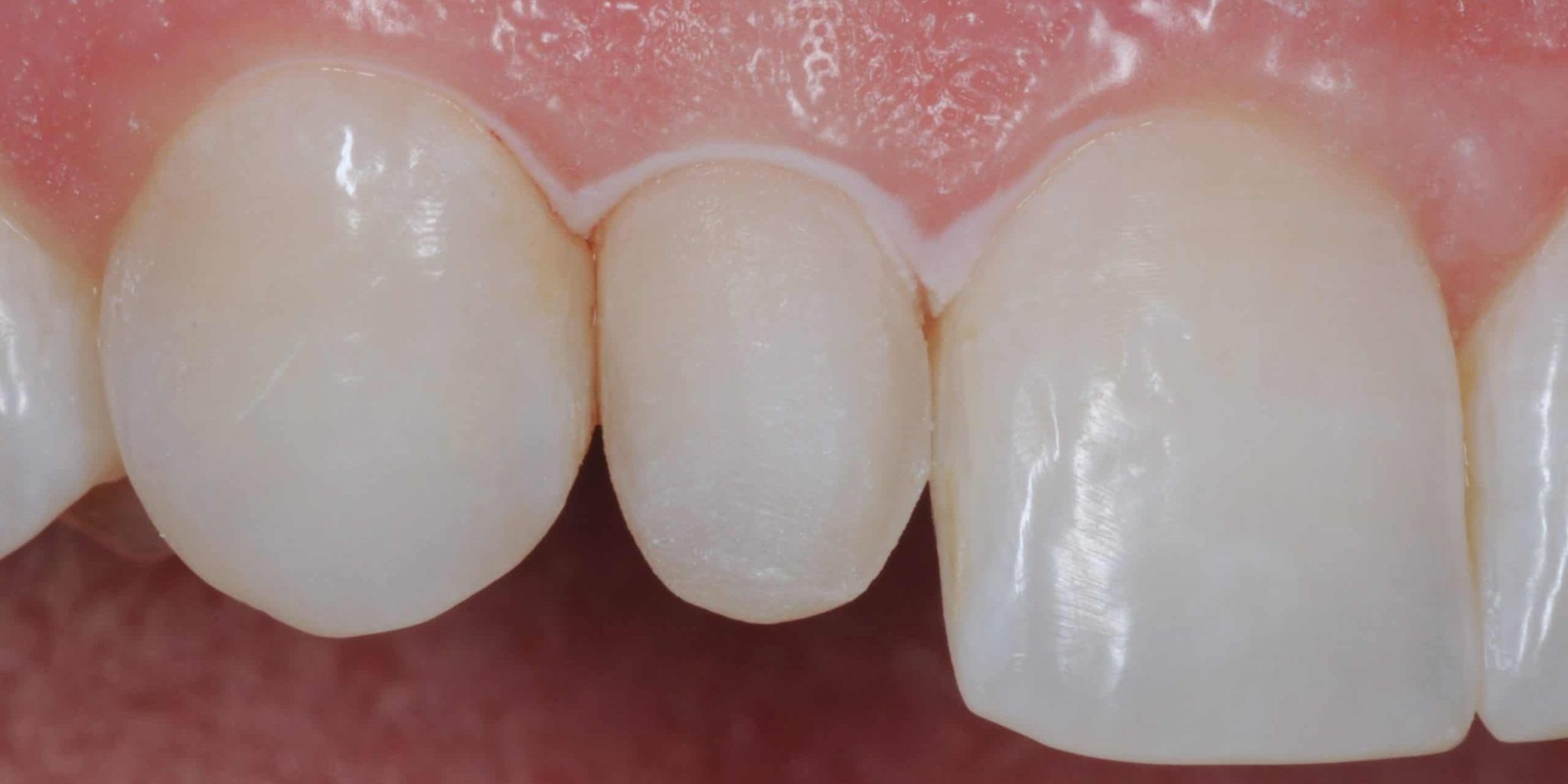 Peg Laterals What They Are And How To Treat Them Dentist Norcross