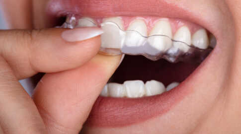 Clear Aligners - Ace Family Dental Orthodontics