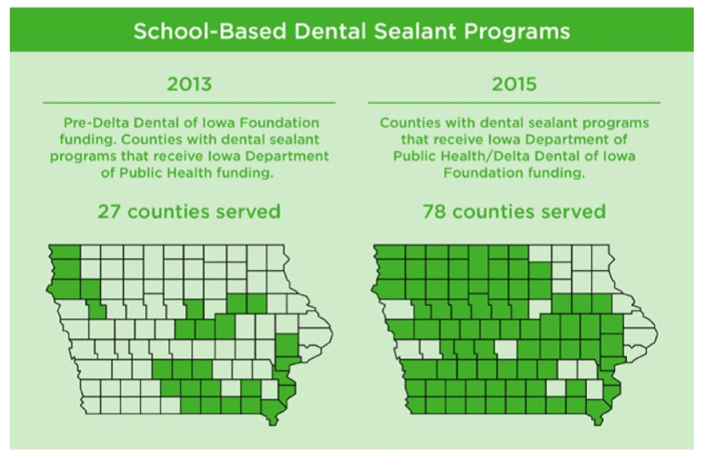 Are Sealants Covered By Delta Dental? Dentist Norcross & Alpharetta, GA