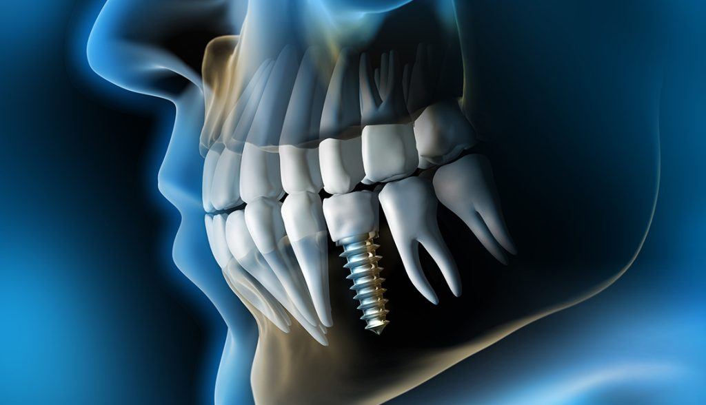 Can Dental Implants Cause Health Problems? Dentist Norcross