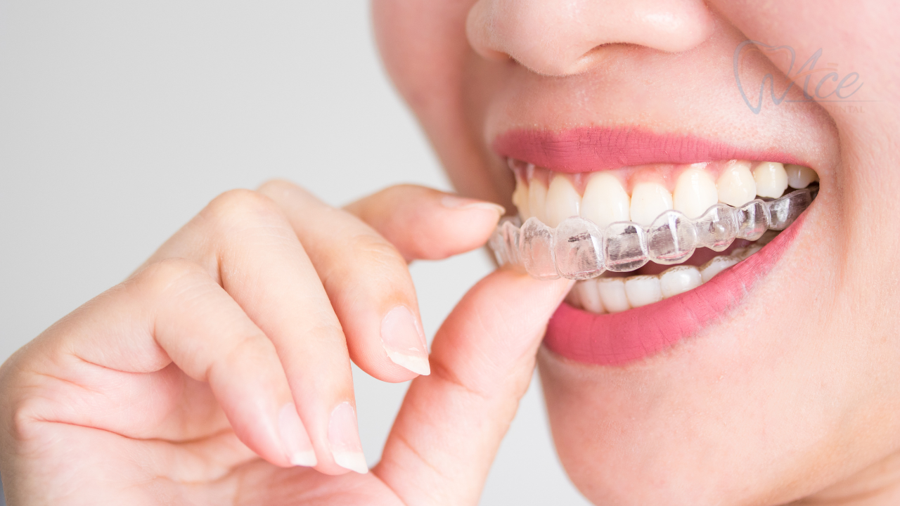 Invisalign services